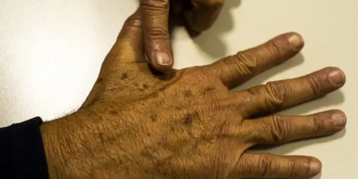 Desinformação sobre câncer de pele prejudica diagnóstico, aponta instituição