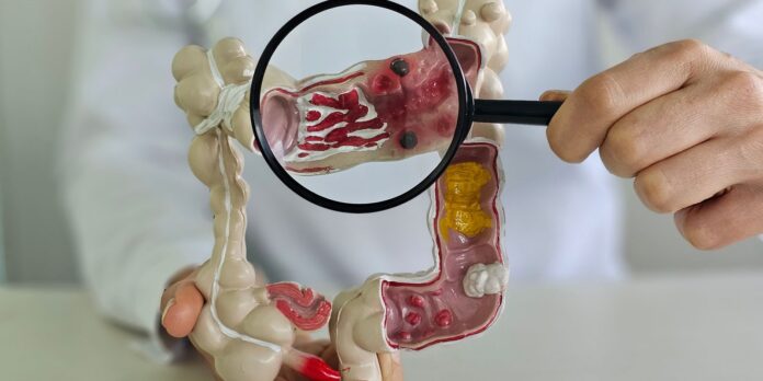 Doença inflamatória intestinal aumenta cinco vezes no Brasil em 13 anos