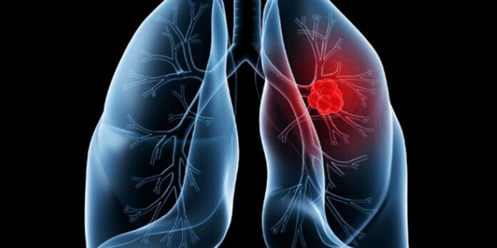 Entenda o adenocarcinoma pulmonar, câncer que afeta o Papa